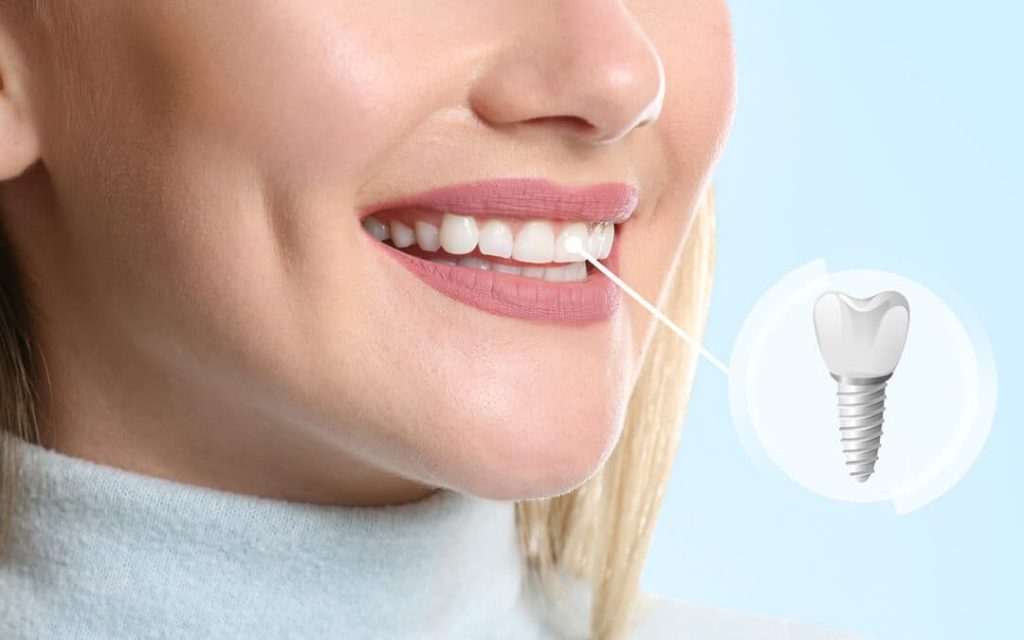 dental implant pars saman teb