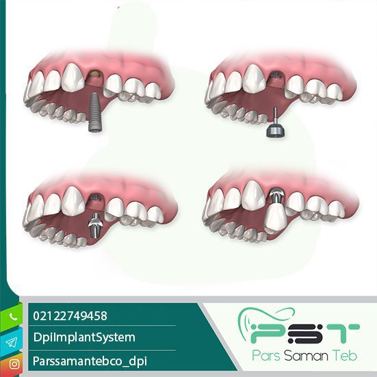 آیا می‌توان بلافاصله بعد از کشیدن دندان ایمپلنت کاشت؟
