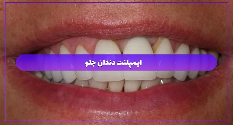 ایمپلنت دندان جلو