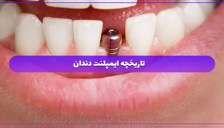 تاریخچه ایمپلنت دندان