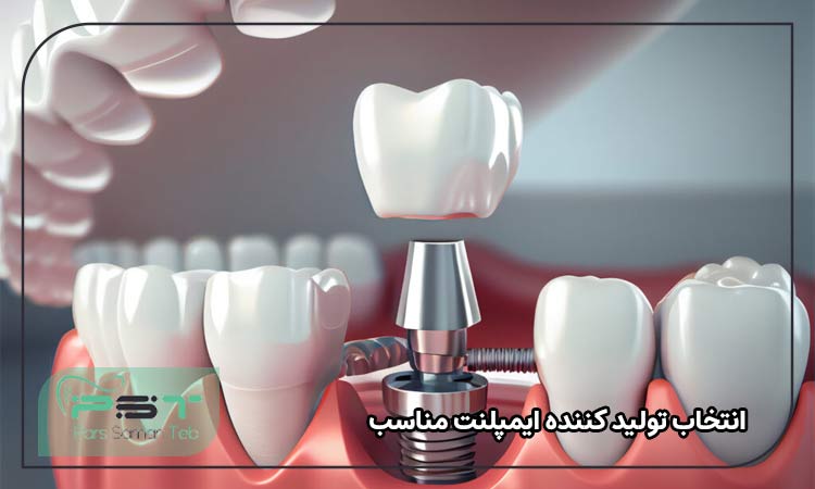 انتخاب تولید کننده ایمپلنت مناسب 