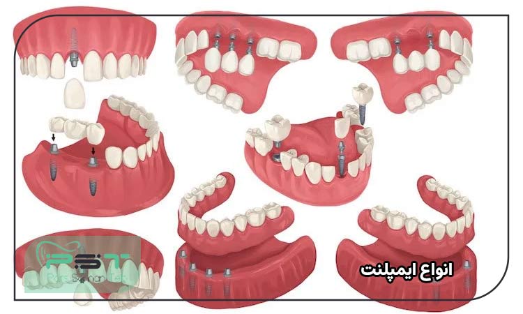 انواع ایمپلنت