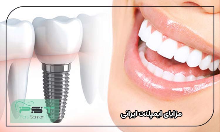مزایای ایمپلنت ایرانی