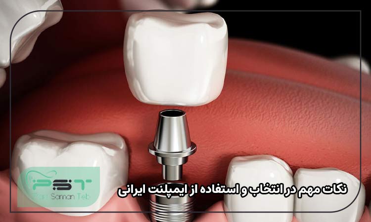 نکات مهم در انتخاب و استفاده از ایمپلنت ایرانی