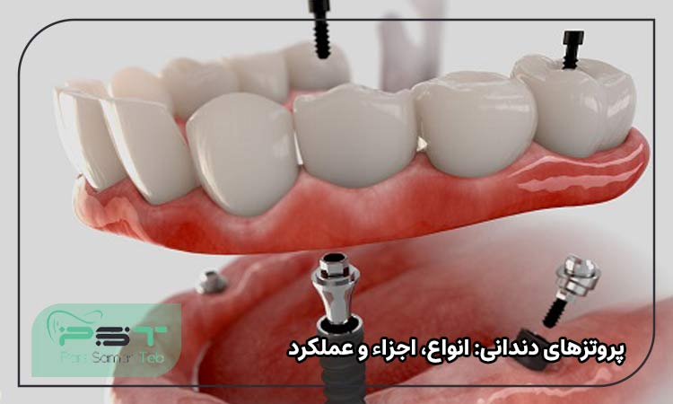  پروتزهای دندانی: انواع، اجزاء و عملکرد

