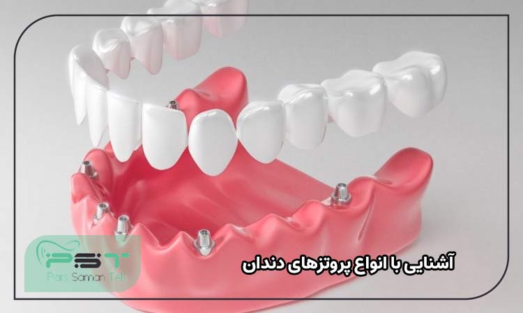 آشنایی با انواع پروتزهای دندان