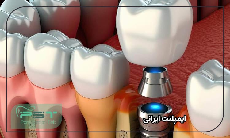 ایمپلنت ایرانی