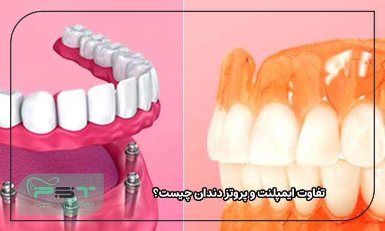 تفاوت ایمپلنت و پروتز دندان چیست؟