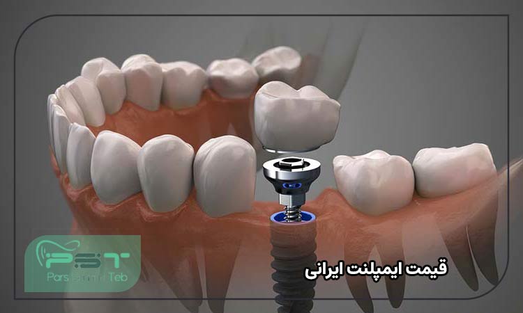 قیمت ایمپلنت ایرانی