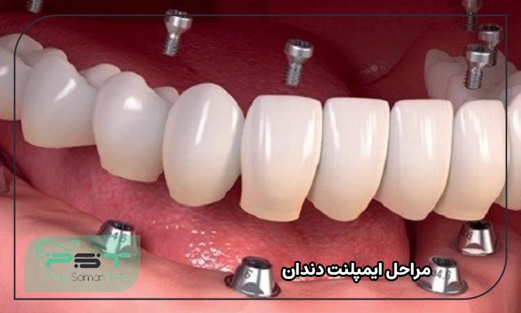 مراحل انجام ایمپلنت دندان