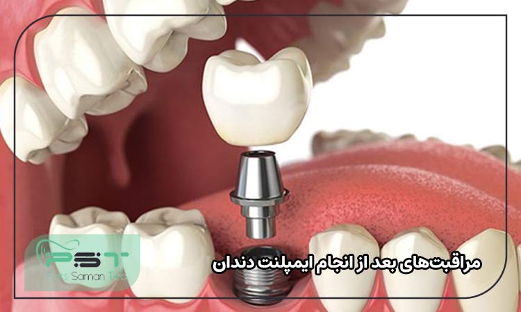 مراقبتهای بعد از انجام ایمپلنت دندان