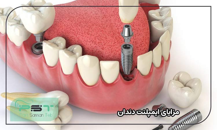 مزایای ایمپلنت دندان 