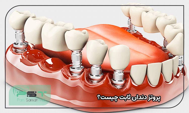 پروتز دندان ثابت چیست؟ 