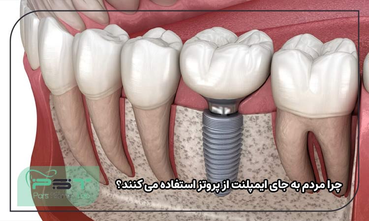 چرا مردم به جای ایمپلنت از پروتز استفاده می کنند؟