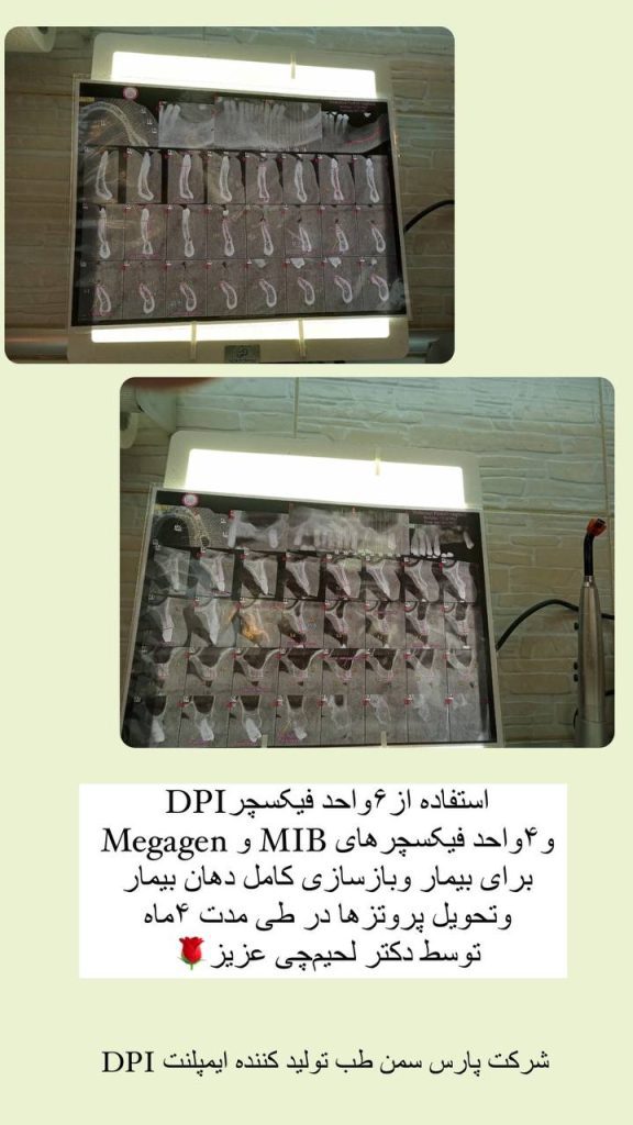 کاشت ۶ واحد فیکسچر DPI و تحویل پروتز به بیمار توسط دکتر لحیم‌چی عزیز