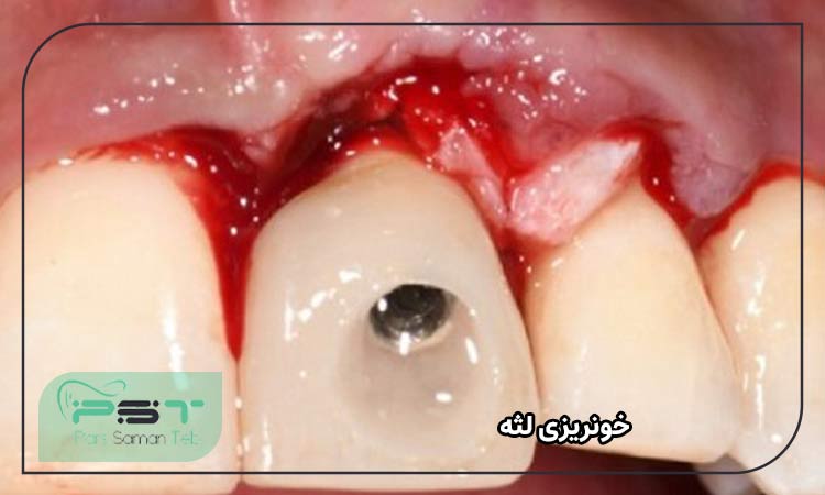 خونریزی لثه