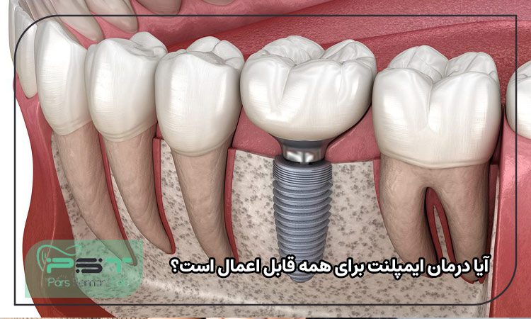 آیا درمان ایمپلنت برای همه قابل اعمال است؟