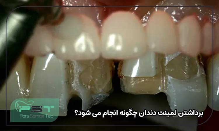 برداشتن لمینت دندان چگونه انجام می شود