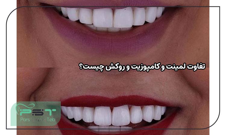 تفاوت لمینت و کامپوزیت و روکش چیست؟