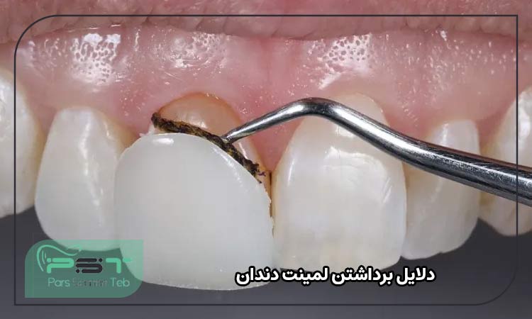 دلایل برداشتن لمینت دندان