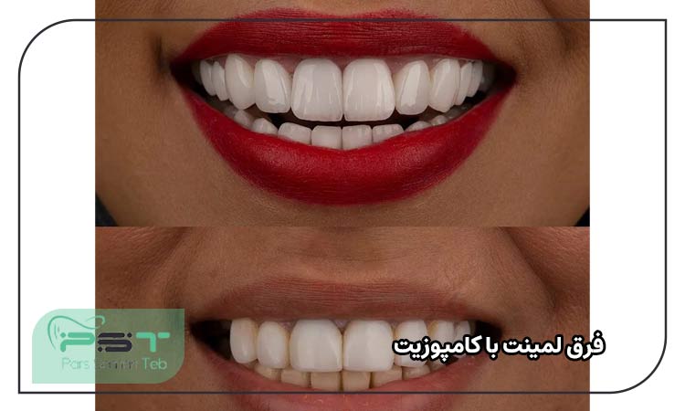 فرق لمینت با کامپوزیت