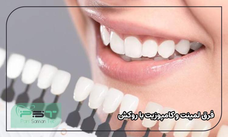 فرق لمینت و کامپوزیت با روکش