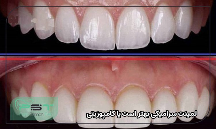 لمینت سرامیکی بهتر است یا کامپوزیتی