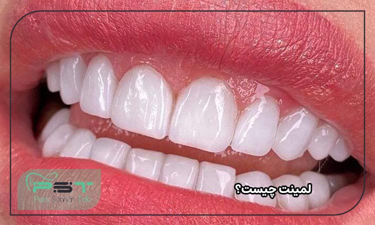 لمینت چیست؟