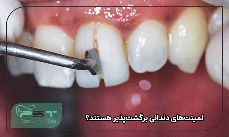 لمینت‌های دندانی برگشت‌پذیر هستند؟