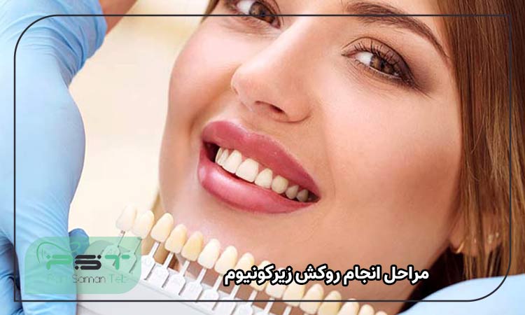 مراحل انجام روکش زیرکونیوم