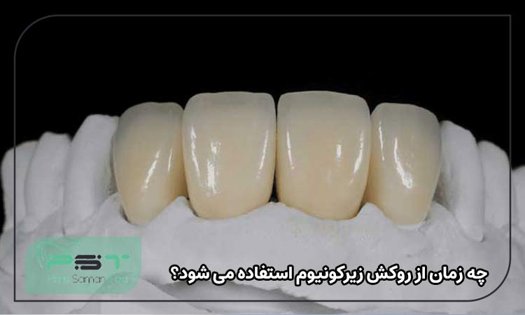 چه زمان از روکش زیرکونیوم استفاده می شود؟