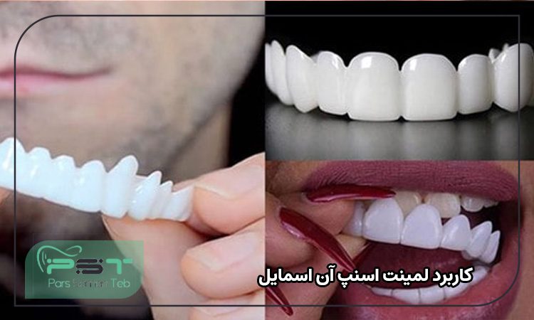 کاربرد لمینت اسنپ آن اسمایل