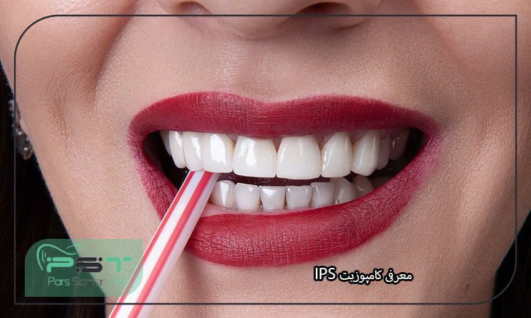 معرفی کامپوزیت IPS مزایا و معایب آن