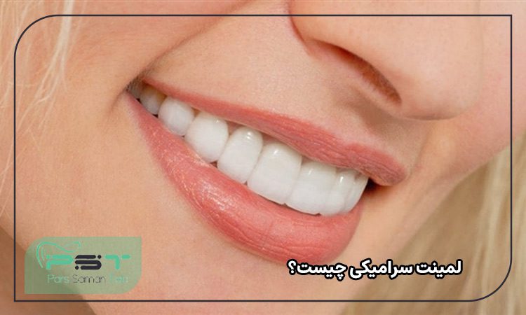 لمینت سرامیکی چیست؟