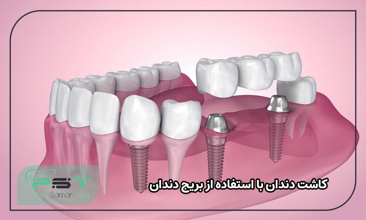 کاشت دندان با استفاده از بریج دندان