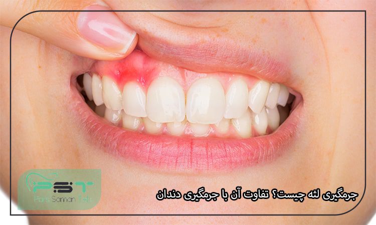 جرمگیری لثه چیست؟ تفاوت آن با جرمگیری دندان