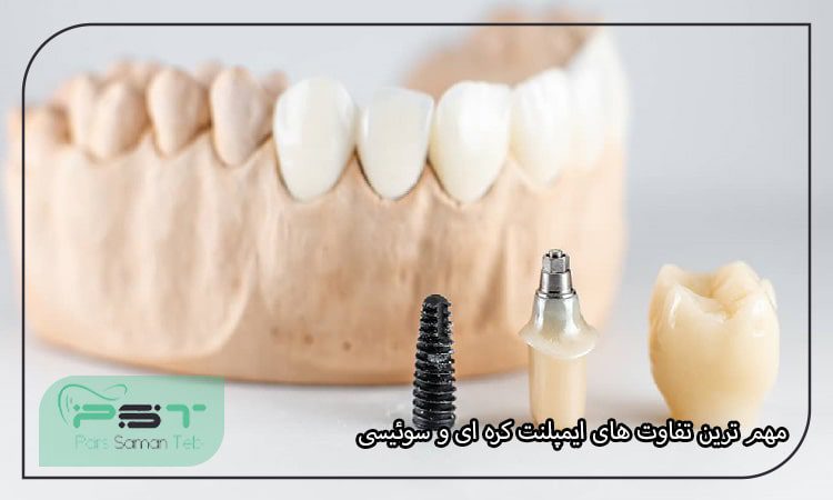 مهم ترین تفاوت های ایمپلنت کره ای و سوئیسی