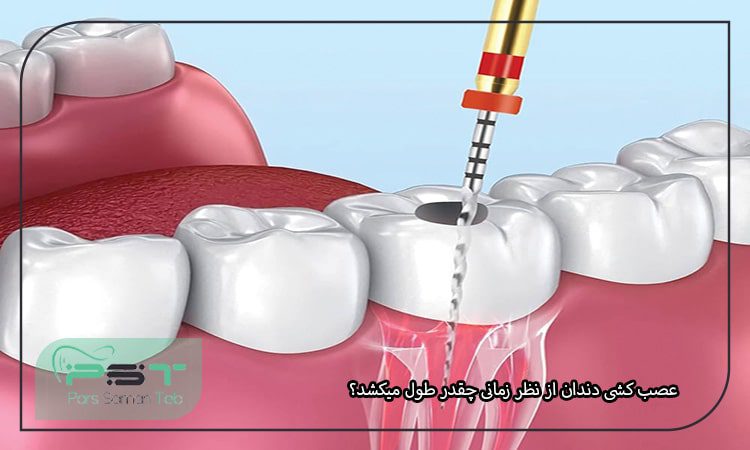 عصب کشی دندان از نظر زمانی چقدر طول میکشد؟