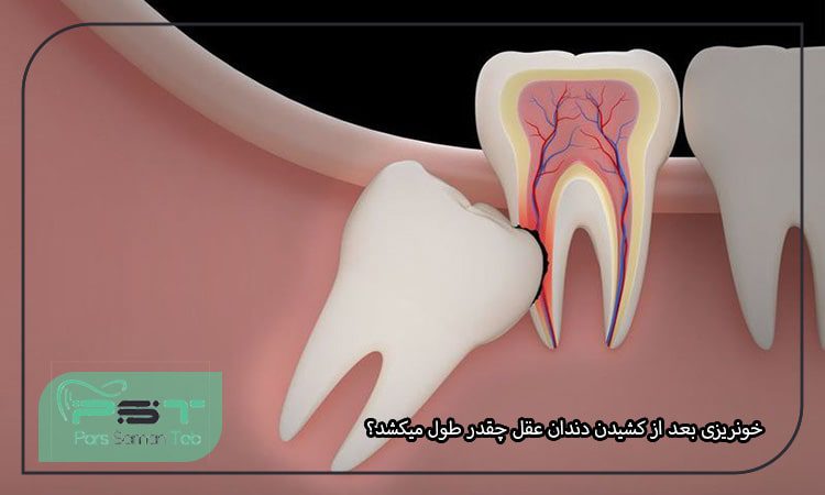 خونریزی بعد از کشیدن دندان عقل چقدر طول میکشد؟