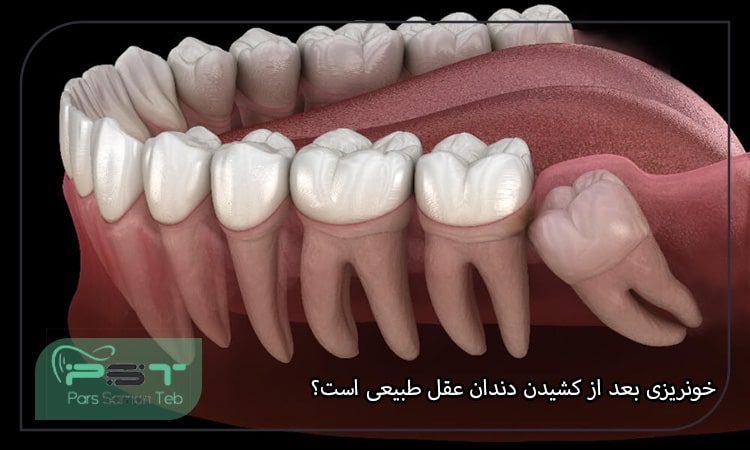 خونریزی بعد از کشیدن دندان عقل طبیعی است؟