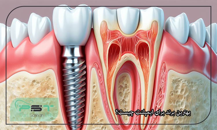 بهترین برند برای ایمپلنت چیست؟