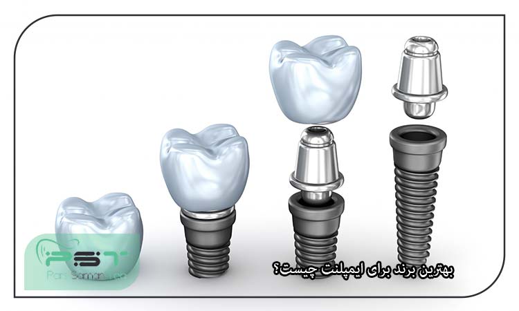 بهترین برند برای ایمپلنت چیست؟