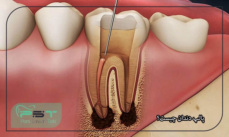 همه چیز راجب پالپ دندان+ روش درمان