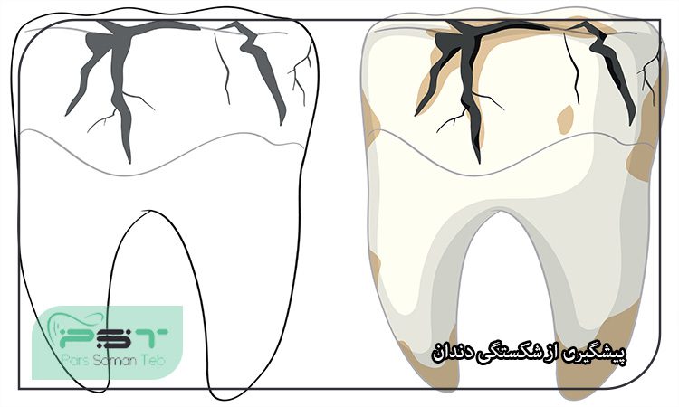 همه چیز راجب شکستگی دندان و درمانهای آن