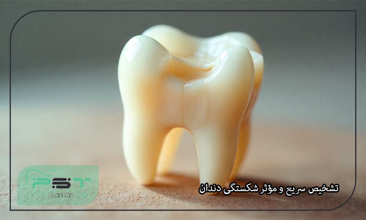 شکستگی دندان