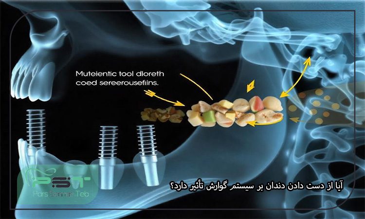 ایمپلنت دندان و سیستم گوارشی