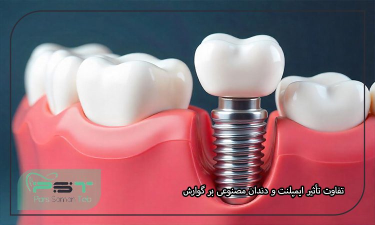 ایمپلنت دندان و سیستم گوارشی