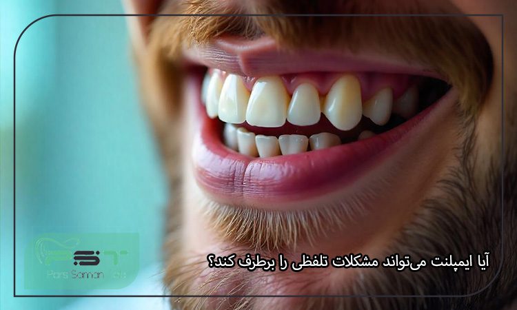 ایمپلنت دندان و تأثیر آن بر گفتار و تلفظ کلمات