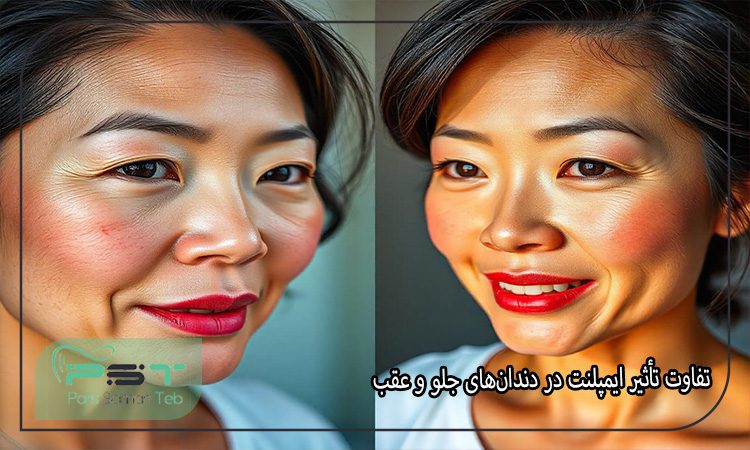 تاثیر ایمپلنت دندان بر چهره