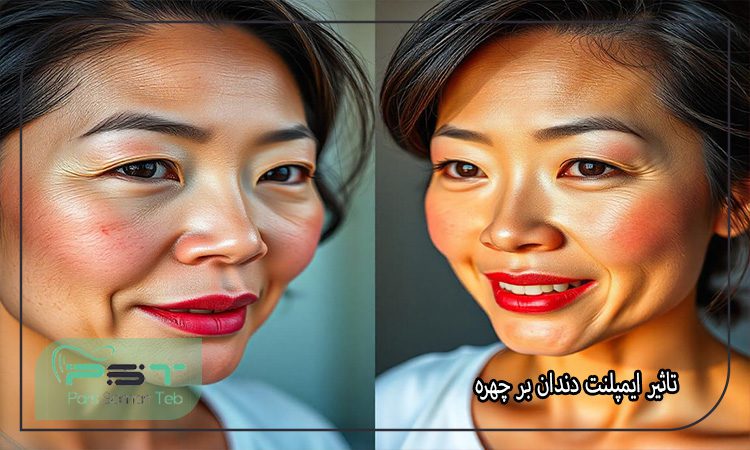 تاثیر ایمپلنت دندان بر چهره